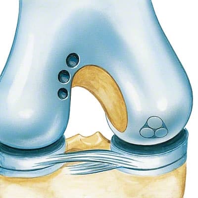 Procart Osteochondral Transplantation-Product Picture Enlargement CW