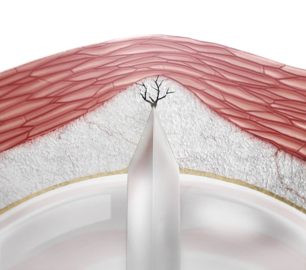 NSE PTA Aperta-PTA High Pressure Scoring Balloon Catheter